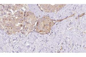ABIN6273326 at 1/100 staining Human thyroid cancer tissue by IHC-P. (SUOX antibody  (Internal Region))