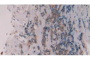 Immunohistochemistry (IHC) image for anti-Matrix Metallopeptidase 11 (Stromelysin 3) (MMP11) (AA 277-488) antibody (ABIN7431380)