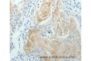 Immunohistochemistry of Human cervical cancer using RNF126 Polyclonal Antibody at dilution of 1:70 (RNF126 antibody)