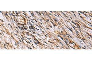 Immunohistochemistry of paraffin-embedded Human colorectal cancer tissue using ECM1 Polyclonal Antibody at dilution of 1:25(x200) (ECM1 antibody)