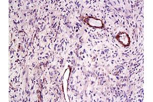 Formalin-fixed and paraffin embedded human laryngeal cancer labeled Anti-CTGF Polyclonal Antibody, Unconjugated (ABIN672636) at 1:200, followed by conjugation to the secondary antibody and DAB staining (CTGF antibody  (AA 221-349))