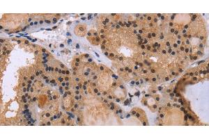 Immunohistochemistry of paraffin-embedded Human thyroid cancer tissue using KIF25 Polyclonal Antibody at dilution 1:40 (KIF25 antibody)