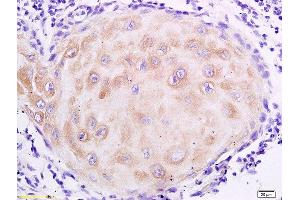 Formalin-fixed and paraffin embedded human oral squamous cell carcinoma labeled with Anti- MUC4 Polyclonal Antibody, Unconjugated  at 1:200 followed by conjugation to the secondary antibody and DAB staining (MUC4 antibody  (AA 1501-1613))