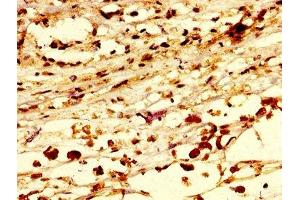 IHC image of ABIN7168252 diluted at 1:300 and staining in paraffin-embedded human melanoma performed on a Leica BondTM system. (RNF219 antibody  (AA 257-465))