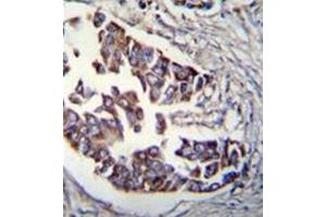 Formalin fixed, paraffin embedded human breast carcinoma stained with RAD9A Antibody  followed by peroxidase conjugation of the secondary antibody and DAB staining. (RAD9A antibody)