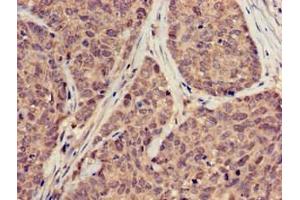 Immunohistochemistry of paraffin-embedded human ovarian cancer using ABIN7169889 at dilution of 1:100 (SUMO3 antibody  (AA 1-92))