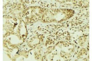 ABIN6267095 at 1/100 staining Human breast cancer tissue by IHC-P.