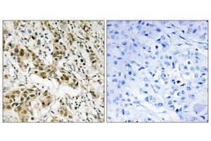 Immunohistochemistry analysis of paraffin-embedded human breast carcinoma tissue using CtBP1 (epitope around residue 422) antibody. (CTBP1 antibody  (Ser422))