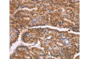Immunohistochemistry of Human liver cancer using NCAPG2 Polyclonal Antibody at dilution of 1:50 (NCAPG2 antibody)
