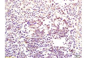 Formalin-fixed and paraffin embedded human lung carcinoma labeled with Anti CKIP-1 Polyclonal Antibody, Unconjugated (ABIN675039) at 1:200 followed by conjugation to the secondary antibody and DAB staining
