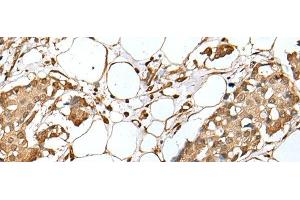 Immunohistochemistry of paraffin-embedded Human breast cancer tissue using UBE2Z Polyclonal Antibody at dilution of 1:35(x200) (UBE2Z antibody)