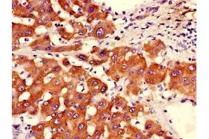 Immunohistochemistry of paraffin-embedded human liver tissue using ABIN7144713 at dilution of 1:100 (Asialoglycoprotein Receptor 2 antibody  (AA 63-286))