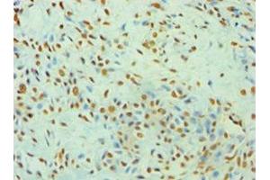 Immunohistochemistry of paraffin-embedded human breast cancer using ABIN7175904 at dilution of 1:100 (XRCC5 antibody  (AA 543-732))
