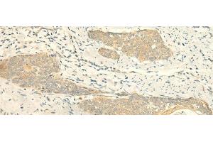 Immunohistochemistry of paraffin-embedded Human esophagus cancer tissue using MPV17 Polyclonal Antibody at dilution of 1:50(x200) (MPV17 antibody)