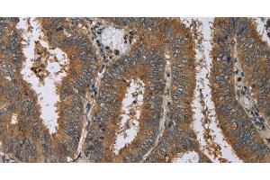 Immunohistochemistry of paraffin-embedded Human colon cancer using HSP40-4 Polyclonal Antibody at dilution of 1:60 (HSP40-4 antibody)