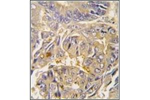 Formalin-fixed and paraffin-embedded human colon carcinoma tissue reacted with Autophagy APG16L Antibody , which was peroxidase-conjugated to the secondary antibody, followed by DAB staining. (ATG16L1 antibody  (AA 84-114))