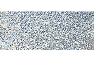 Immunohistochemistry of paraffin-embedded Human tonsil tissue using SLC35F6 Polyclonal Antibody at dilution of 1:95(x200)