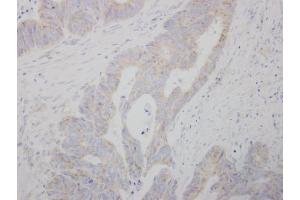 IHC-P Image COMT antibody detects COMT protein at cytosol on human colon carcinoma by immunohistochemical analysis. (COMT antibody)