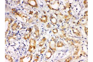 Anti- LOXL1 Picoband antibody, IHC(P) IHC(P): Human Prostatic Cancer Tissue (LOXL1 antibody  (C-Term))