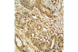 Immunohistochemistry analysis in formalin fixed and paraffin embedded human colon carcinoma reacted with MCM2 Antibody (C-term) followed which was peroxidase conjugated to the secondary antibody and followed by DAB staining.