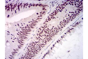 Immunohistochemical analysis of paraffin-embedded rectum cancer tissues using KMT2D mouse mAb with DAB staining. (Lysine (K)-Specific Methyltransferase 2B (KMT2B) (AA 445-599) antibody)