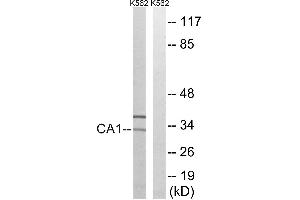 Immunohistochemistry analysis of paraffin-embedded human colon carcinoma tissue, using CA1 antibody. (CA1 antibody)