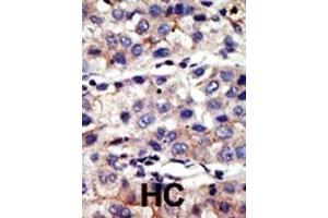 Formalin-fixed and paraffin-embedded human cancer tissue reacted with the primary antibody, which was peroxidase-conjugated to the secondary antibody, followed by AEC staining. (CBX4 antibody  (N-Term))