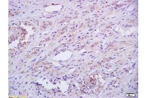 Formalin-fixed and paraffin embedded human cervical carcinoma labeled with Rabbit Anti Phospho-IRAK1 (Thr387) Polyclonal Antibody, Unconjugated (ABIN742673) at 1:200 followed by conjugation to the secondary antibody and DAB staining