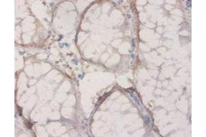 Immunohistochemistry of paraffin-embedded human colon cancer using ABIN7142468 at dilution of 1:20 (HPD antibody  (AA 2-393))