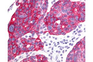 Anti-GHRHR antibody IHC of human Ovary, Carcinoma. (GHRHR antibody  (N-Term))