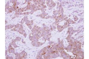 IHC-P Image Immunohistochemical analysis of paraffin-embedded human breast cancer, using CPNE6, antibody at 1:250 dilution. (CPNE6 antibody)