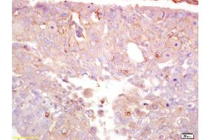 Formalin-fixed and paraffin embedded human lung carcinoma labeled with Anti-TRPM7 Polyclonal Antibody, Unconjugated  at 1:200 followed by conjugation to the secondary antibody and DAB staining (TRPM7 antibody  (AA 800-850))