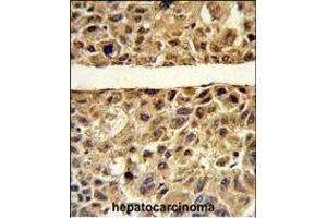 Formalin-fixed and paraffin-embedded human hepatocarcinoma reacted with ARG1 Antibody (C-term), which was peroxidase-conjugated to the secondary antibody, followed by DAB staining. (Liver Arginase antibody  (C-Term))
