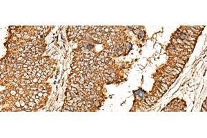 Immunohistochemistry of paraffin-embedded Human colorectal cancer tissue using ATP5I Polyclonal Antibody at dilution of 1:65(x200) (ATP5I antibody)