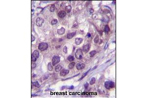 NR3C1 Antibody (Center) (ABIN651659 and ABIN2840347) immunohistochemistry analysis in formalin fixed and paraffin embedded human breast carcinoma followed by peroxidase conjugation of the secondary antibody and DAB staining.