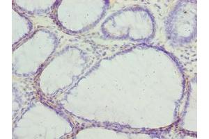 Immunohistochemistry of paraffin-embedded human colon cancer using ABIN7153655 at dilution of 1:100 (MLZE antibody  (AA 1-508))