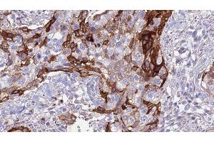 ABIN6276996 at 1/100 staining Human urothelial cancer tissue by IHC-P. (ACVR2A antibody  (Internal Region))