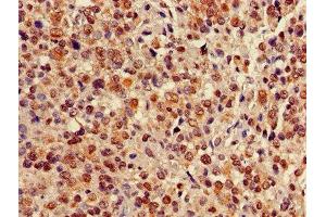 Immunohistochemistry of paraffin-embedded human glioma using ABIN7147705 at dilution of 1:100 (CBX5 antibody  (AA 1-191))