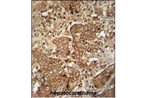 CS antibody (C-term) 10677b immunohistochemistry analysis in formalin fixed and paraffin embedded human hepatocarcinoma followed by peroxidase conjugation of the secondary antibody and DAB staining. (APCS antibody  (C-Term))