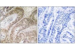 Immunohistochemistry analysis of paraffin-embedded human colon carcinoma, using RDM1 Antibody.
