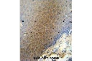 CEP70 antibody (Center) (ABIN654603 and ABIN2844302) immunohistochemistry analysis in formalin fixed and paraffin embedded human skin carcinoma followed by peroxidase conjugation of the secondary antibody and DAB staining. (CEP70 antibody  (AA 309-338))