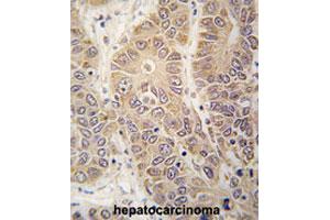 Formalin-fixed and paraffin-embedded human hepatocarcinomareacted with HARS polyclonal antibody , which was peroxidase-conjugated to the secondary antibody, followed by AEC staining. (HARS1/Jo-1 antibody  (N-Term))