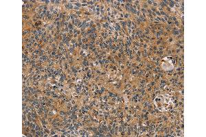 Immunohistochemistry of Human cervical cancer using TAC1 Polyclonal Antibody at dilution of 1:25 (TAC1 antibody)