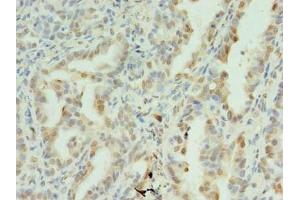 Immunohistochemistry of paraffin-embedded human lung cancer using ABIN7170902 at dilution of 1:100 (SDHC antibody  (AA 30-62))