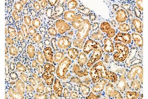 ABIN6266358 and ABIN6276703 at 1/100 staining Human kidney cancer and adjacent normal tissues by IHC-P.