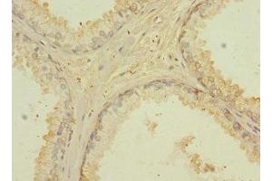Immunohistochemistry of paraffin-embedded human prostate cancer using ABIN7147148 at dilution of 1:100 (CD276 antibody  (AA 29-200))