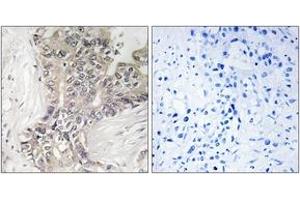 Immunohistochemistry analysis of paraffin-embedded human liver carcinoma tissue, using B3GALTL Antibody. (B3GALTL antibody  (AA 449-498))