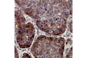 Immunohistochemical analysis of TRAPPC5 staining in human lung cancer formalin fixed paraffin embedded tissue section.
