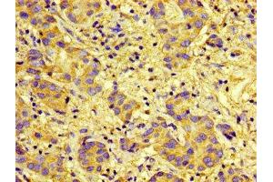 Immunohistochemistry of paraffin-embedded human liver cancer using ABIN7146111 at dilution of 1:100 (CXCR5 antibody  (AA 1-55))