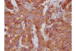 IHC image of ABIN7127403 diluted at 1:100 and staining in paraffin-embedded human breast cancer performed on a Leica BondTM system.